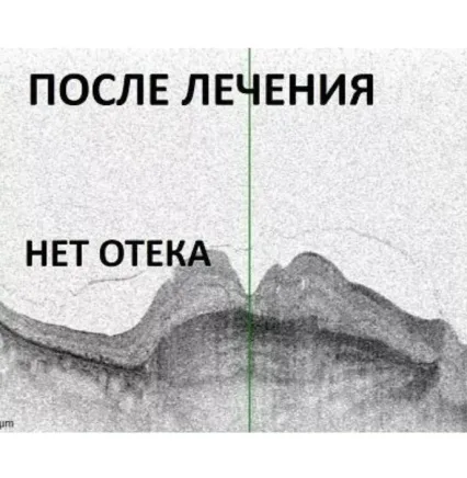 ОКТ після лікування ВМД