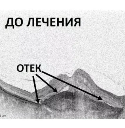 ОКТ до лікування ВМД