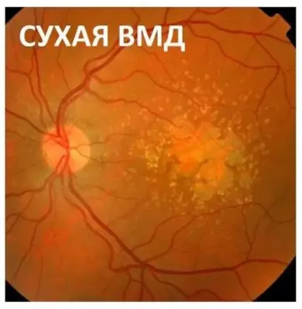 Сітківка із сухою формою вікової макулодистрофії