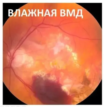 Сітківка з вологою формою вікової макулодистрофії