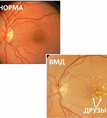 Діагностика макулодистрофії